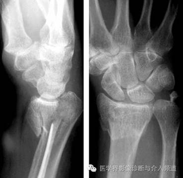 涨知识!20种骨折平片你见过几种? 涨知识!20种骨折平片你见过几种?