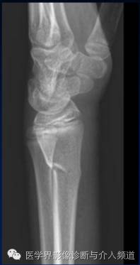 涨知识!20种骨折平片你见过几种? 涨知识!20种骨折平片你见过几种?