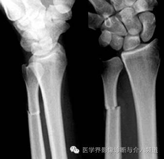 涨知识!20种骨折平片你见过几种? 涨知识!20种骨折平片你见过几种?