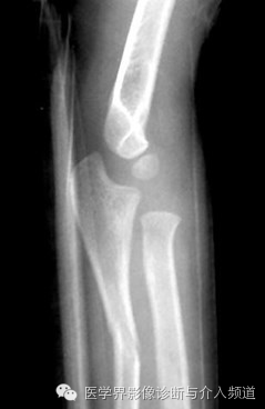 涨知识!20种骨折平片你见过几种? 涨知识!20种骨折平片你见过几种?