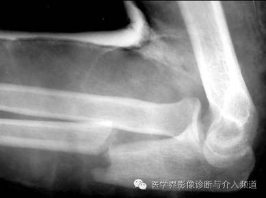 涨知识!20种骨折平片你见过几种? 涨知识!20种骨折平片你见过几种?