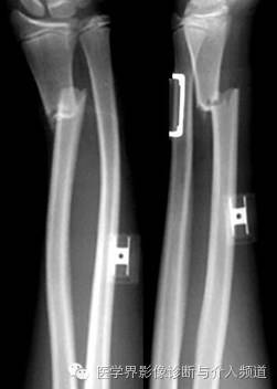 涨知识!20种骨折平片你见过几种? 涨知识!20种骨折平片你见过几种?