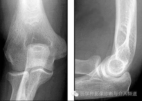 涨知识!20种骨折平片你见过几种? 涨知识!20种骨折平片你见过几种?