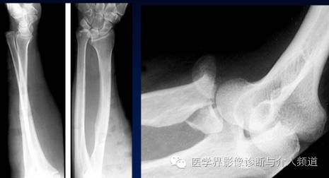 涨知识!20种骨折平片你见过几种? 涨知识!20种骨折平片你见过几种?