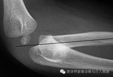 涨知识!20种骨折平片你见过几种? 涨知识!20种骨折平片你见过几种?