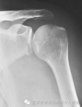涨知识!20种骨折平片你见过几种? 涨知识!20种骨折平片你见过几种?
