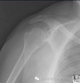 涨知识!20种骨折平片你见过几种? 涨知识!20种骨折平片你见过几种?