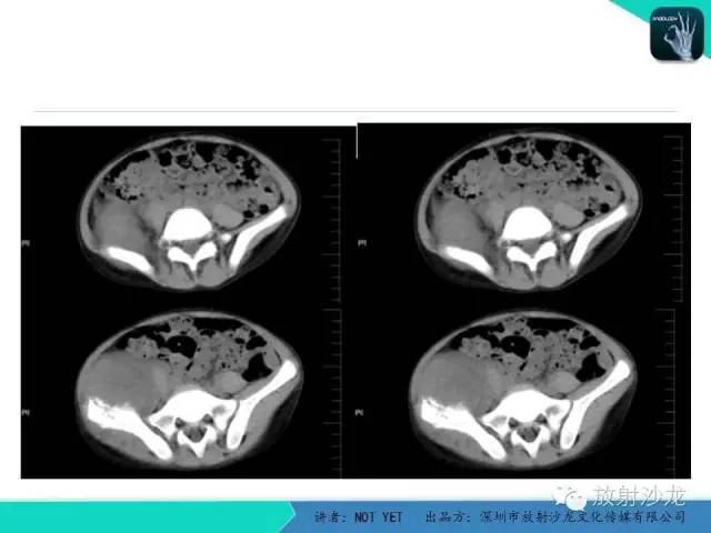 【病例】右侧髂骨Ewing肉瘤1例CT影像表现