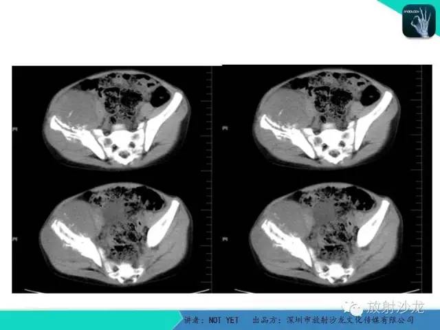【病例】右侧髂骨Ewing肉瘤1例CT影像表现