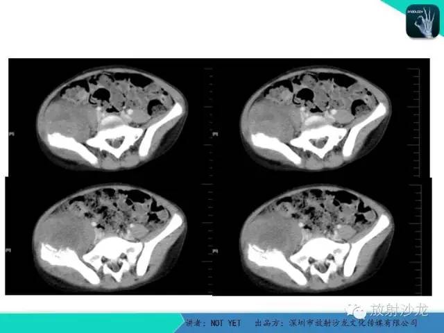 【病例】右侧髂骨Ewing肉瘤1例CT影像表现