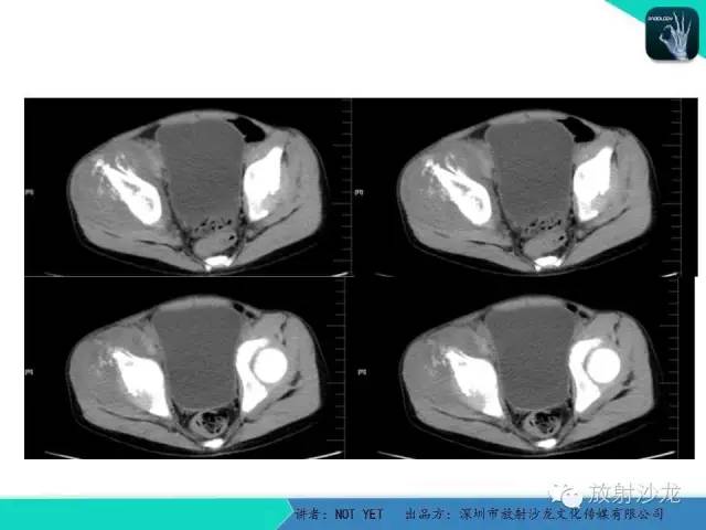 【病例】右侧髂骨Ewing肉瘤1例CT影像表现