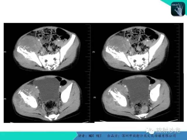 【病例】右侧髂骨Ewing肉瘤1例CT影像表现