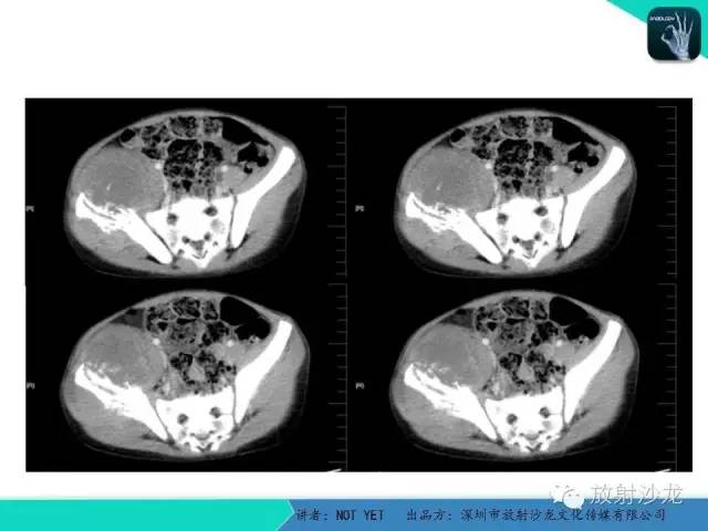 【病例】右侧髂骨Ewing肉瘤1例CT影像表现