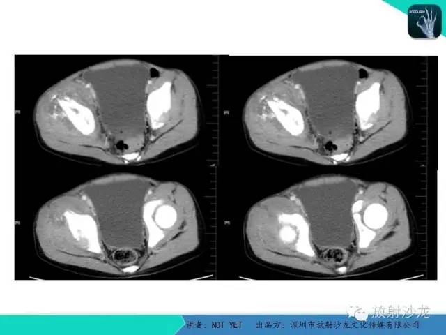 【病例】右侧髂骨Ewing肉瘤1例CT影像表现