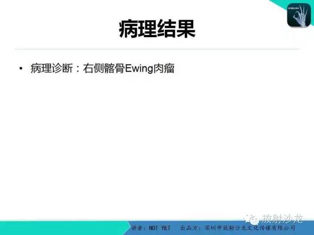 【病例】右侧髂骨Ewing肉瘤1例CT影像表现