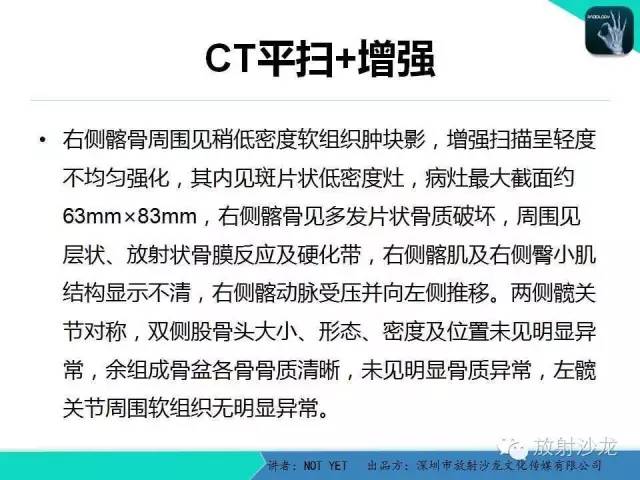 【病例】右侧髂骨Ewing肉瘤1例CT影像表现