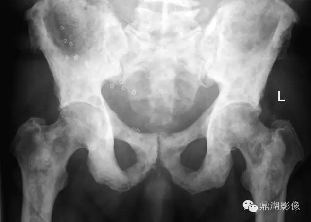 常见骨转移肿瘤大汇总 常见骨转移肿瘤大汇总