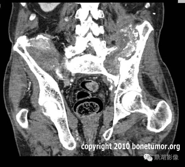 常见骨转移肿瘤大汇总 常见骨转移肿瘤大汇总