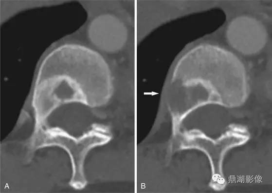 常见骨转移肿瘤大汇总 常见骨转移肿瘤大汇总