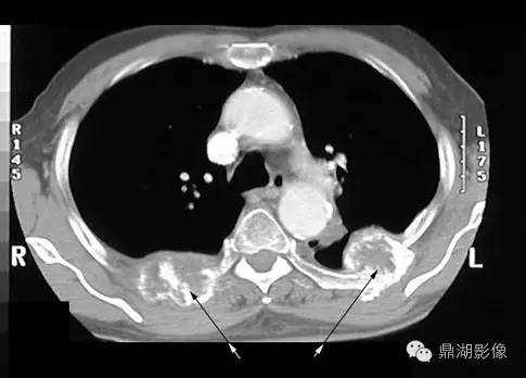 常见骨转移肿瘤大汇总 常见骨转移肿瘤大汇总