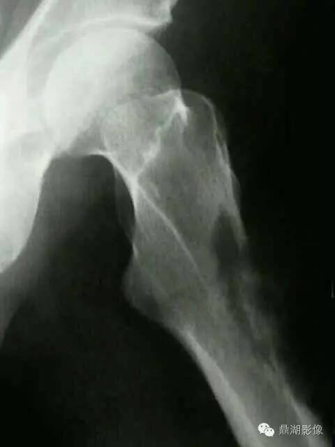 常见骨转移肿瘤大汇总 常见骨转移肿瘤大汇总