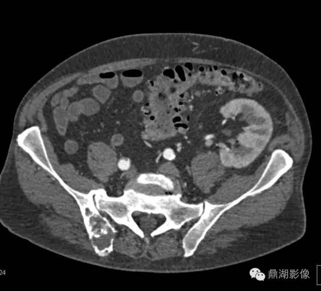 常见骨转移肿瘤大汇总 常见骨转移肿瘤大汇总