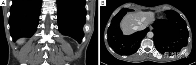 常见骨转移肿瘤大汇总 常见骨转移肿瘤大汇总