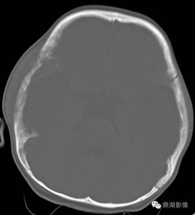 常见骨转移肿瘤大汇总 常见骨转移肿瘤大汇总