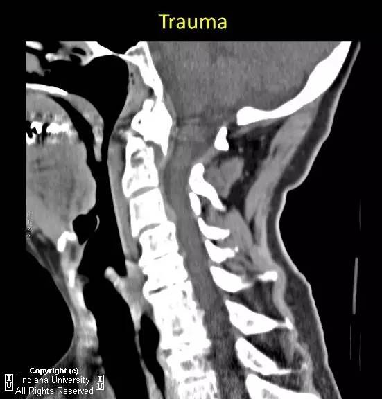 【病例】II型齿状突骨折1例