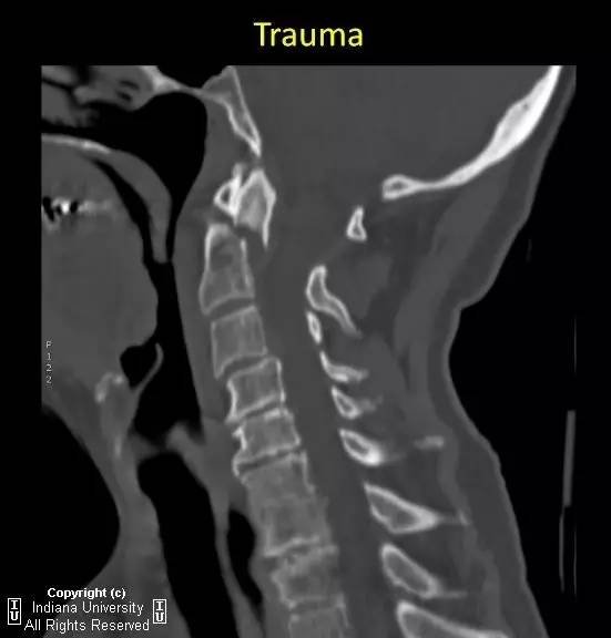 【病例】II型齿状突骨折1例