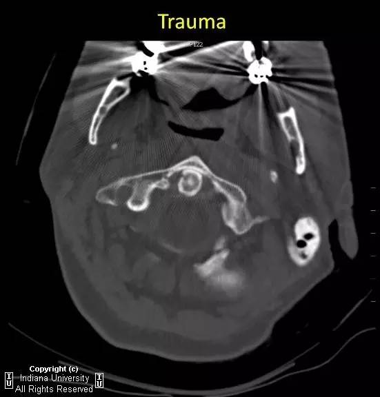 【病例】II型齿状突骨折1例