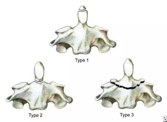 【病例】II型齿状突骨折1例