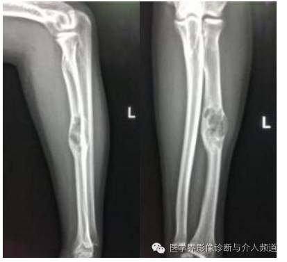 【病例】桡骨动脉瘤样骨囊肿1例X线及MR影像表现 【病例】桡骨动脉瘤样骨囊肿1例X线及MR影像表现