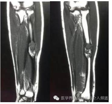 【病例】桡骨动脉瘤样骨囊肿1例X线及MR影像表现 【病例】桡骨动脉瘤样骨囊肿1例X线及MR影像表现