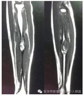 【病例】桡骨动脉瘤样骨囊肿1例X线及MR影像表现 【病例】桡骨动脉瘤样骨囊肿1例X线及MR影像表现