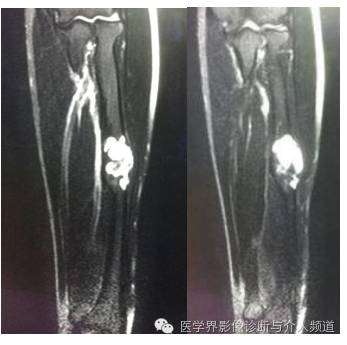 【病例】桡骨动脉瘤样骨囊肿1例X线及MR影像表现 【病例】桡骨动脉瘤样骨囊肿1例X线及MR影像表现