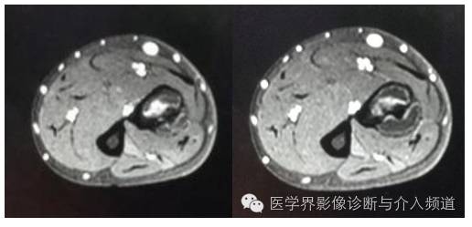 【病例】桡骨动脉瘤样骨囊肿1例X线及MR影像表现 【病例】桡骨动脉瘤样骨囊肿1例X线及MR影像表现