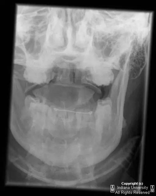 【病例】Jefferson骨折1例X线CT及MR影像表现