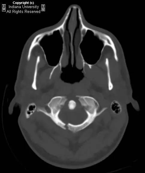 【病例】Jefferson骨折1例X线CT及MR影像表现
