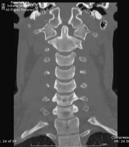 【病例】Jefferson骨折1例X线CT及MR影像表现