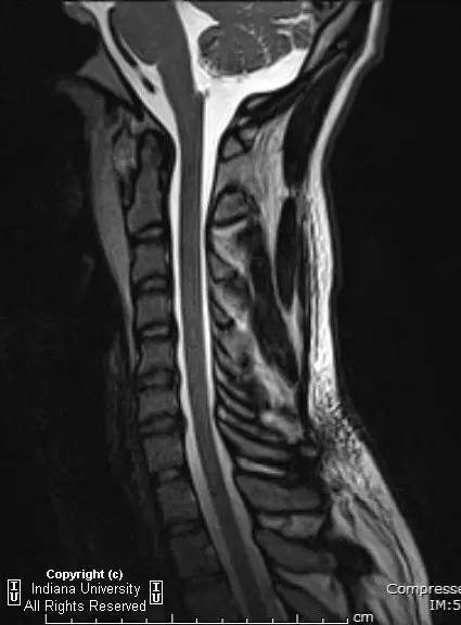 【病例】Jefferson骨折1例X线CT及MR影像表现