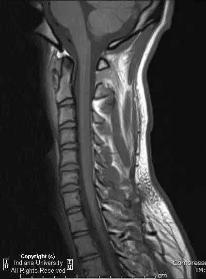 【病例】Jefferson骨折1例X线CT及MR影像表现