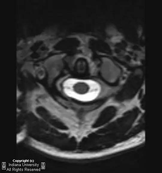 【病例】Jefferson骨折1例X线CT及MR影像表现