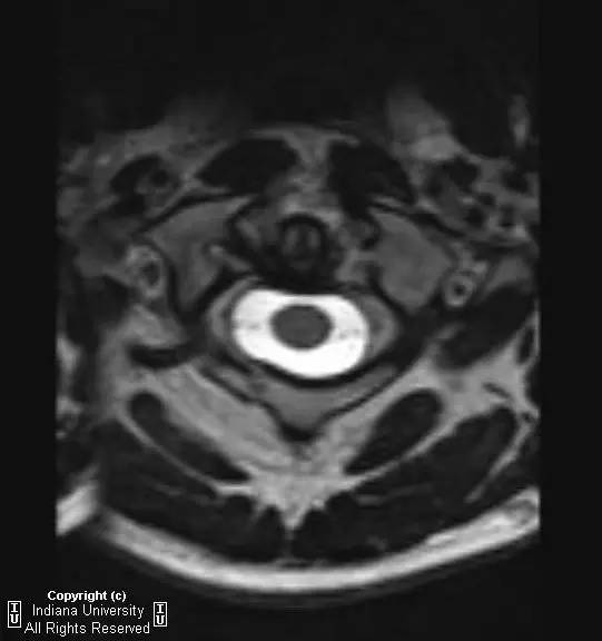 【病例】Jefferson骨折1例X线CT及MR影像表现