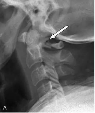 【病例】Jefferson骨折1例X线CT及MR影像表现