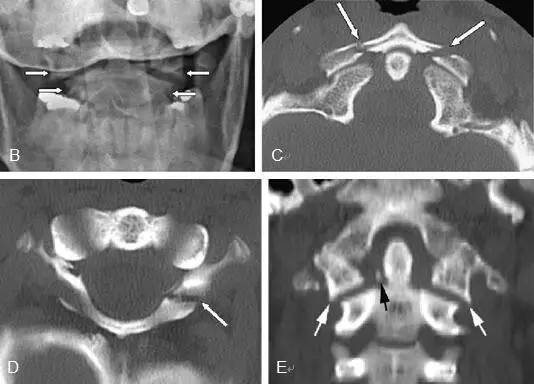 【病例】Jefferson骨折1例X线CT及MR影像表现