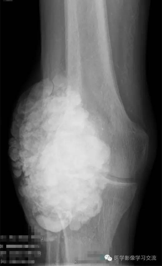 【病例】肿瘤样钙盐沉着症1例X线影像表现