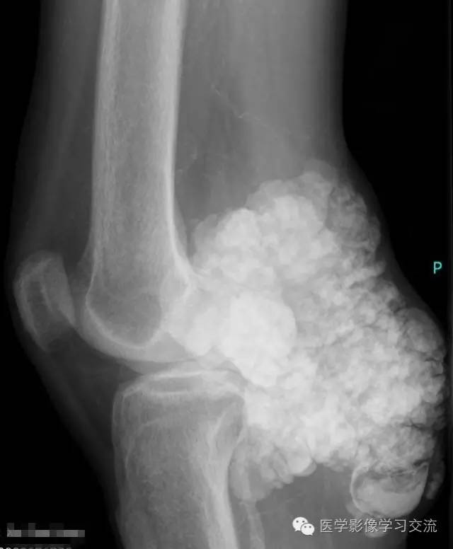 【病例】肿瘤样钙盐沉着症1例X线影像表现