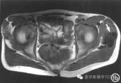【病例】肿瘤样钙盐沉着症1例X线影像表现
