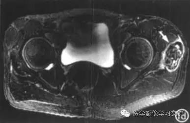 【病例】肿瘤样钙盐沉着症1例X线影像表现